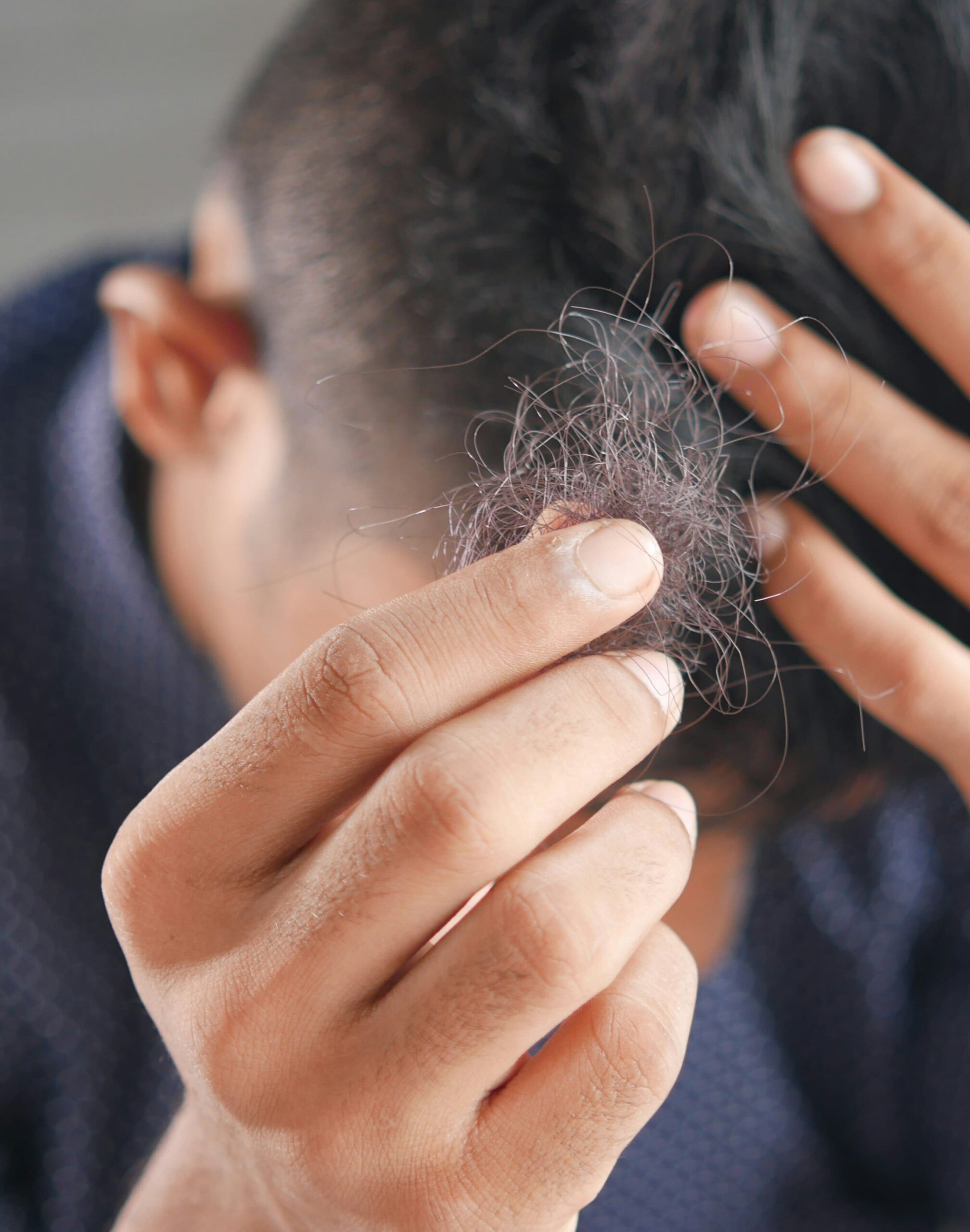 Trichotillomania należy do zaburzeń obsesyjno-kompulsyjnych